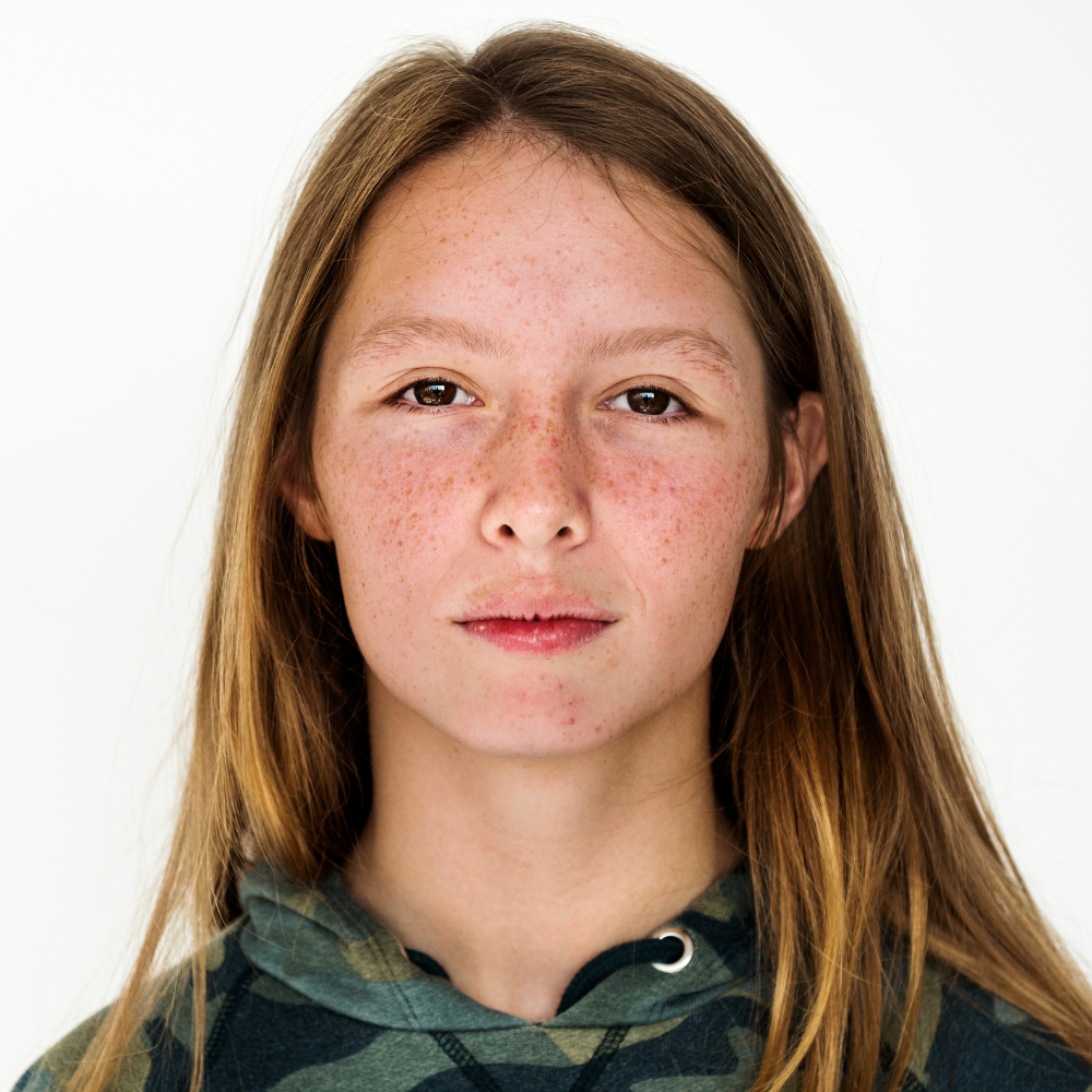 Understanding Acne in Teenagers and Kids: Causes, Treatment, and Prevention
