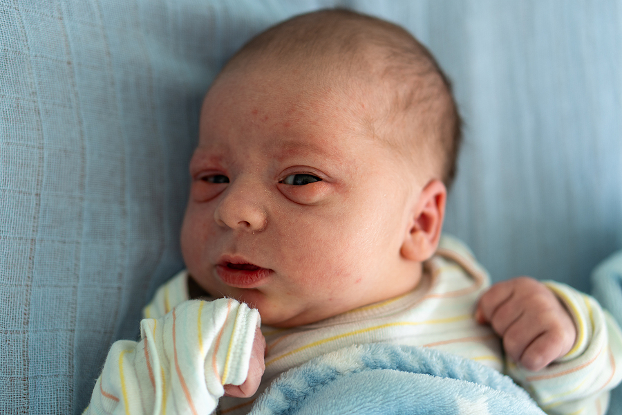 All About Acne in Children