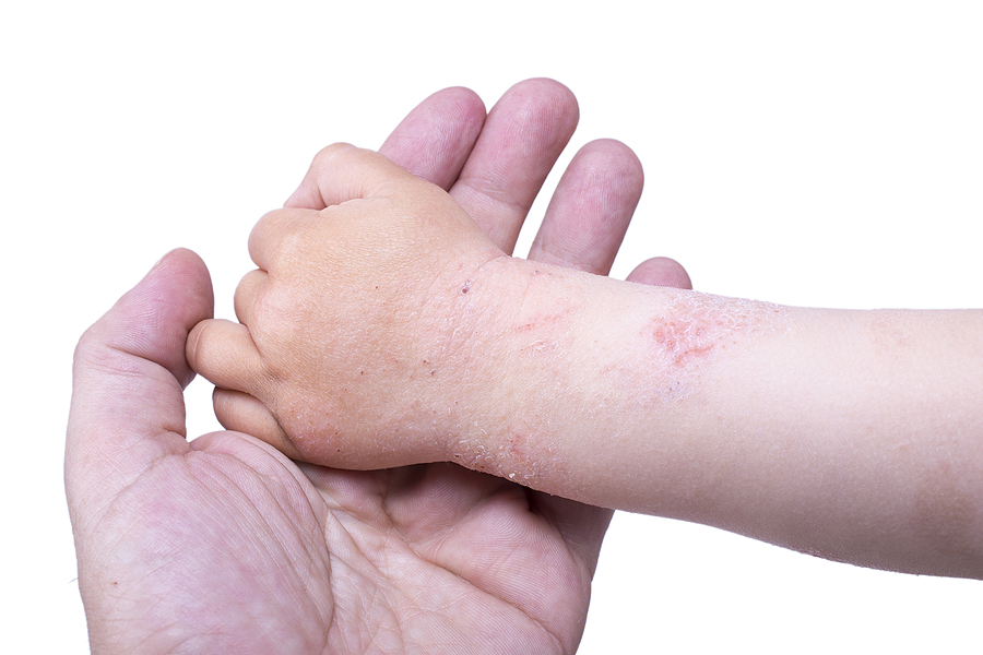 Comprehensive Pediatric Care: Managing Eczema in San Pedro, CA at Your Trusted Pediatric Office